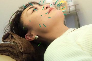 美容鍼✨