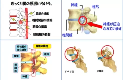 腰痛症のいろいろ