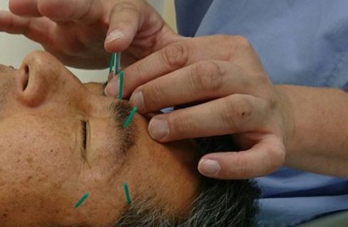 老眼にも美容鍼