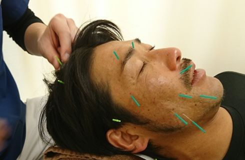 男性にも美容鍼