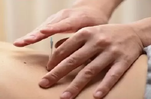 腰痛には鍼治療