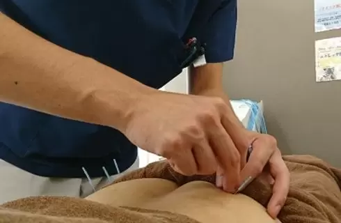 鍼治療
