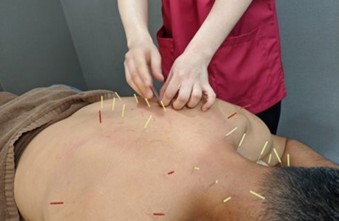 鍼治療