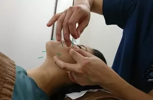 美容鍼効果③
