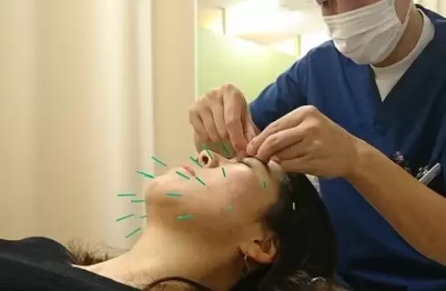 美容鍼効果①