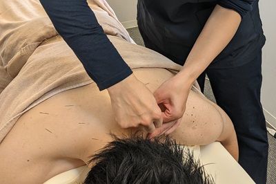 むち打ち症に鍼治療