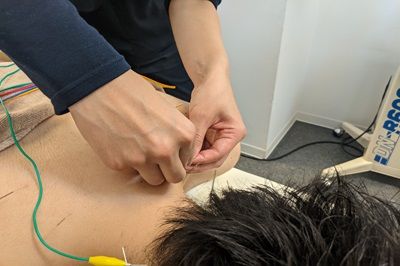 鍼治療