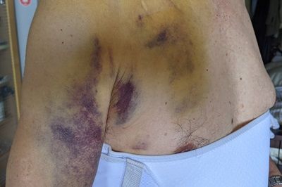 交通事故によるケガの治療