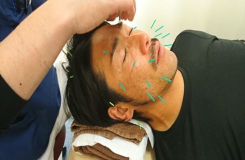 男性にも人気の美容鍼