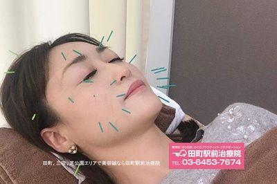 美容鍼で改善できること