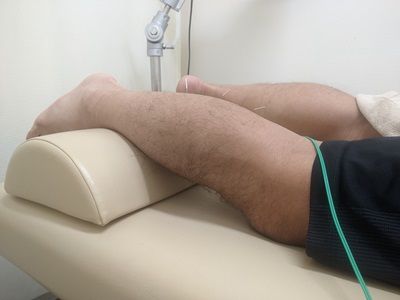 ふくらはぎの肉離れに鍼治療