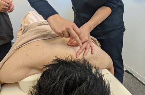 鍼治療