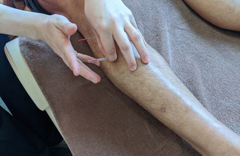 鍼治療