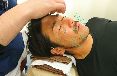 眼精疲労に美容鍼