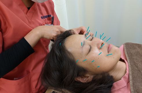 美肌に美容鍼